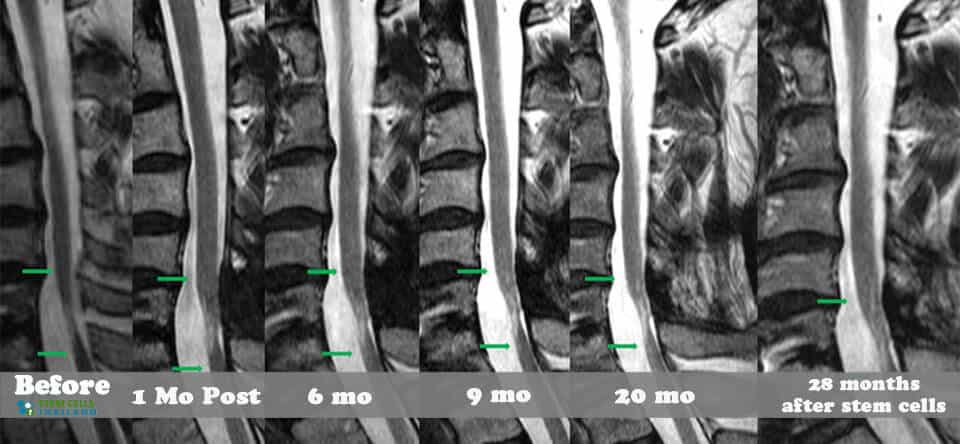 spinal-cord-injury-repair-thailand