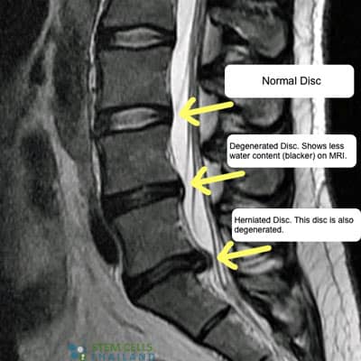 DDD-Before-After-treatment-MRI