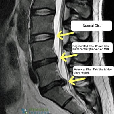 Before-After-stem-cell-treatment-for-DDD-MRI