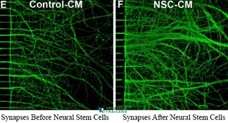 before-after-neural-stem-cell-transplants