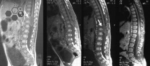 ddd stem cell therapy