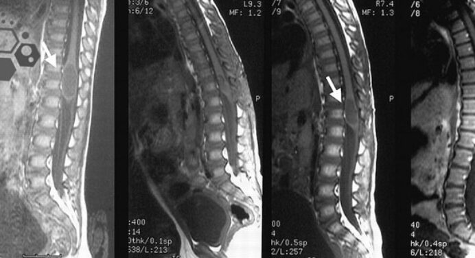 Iliac Crest Bone Marrow Aspiration and Grafting Site
