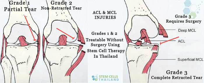 grade-1-2-retractable-acl-mcl-tear-stem-cell-therapy