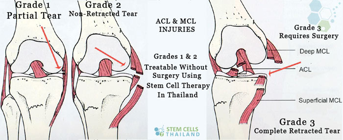 Stem Cell Therapy and The Recovery Process: Regenerative Sport