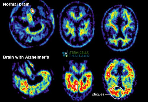normal brain vs alzheimers patient