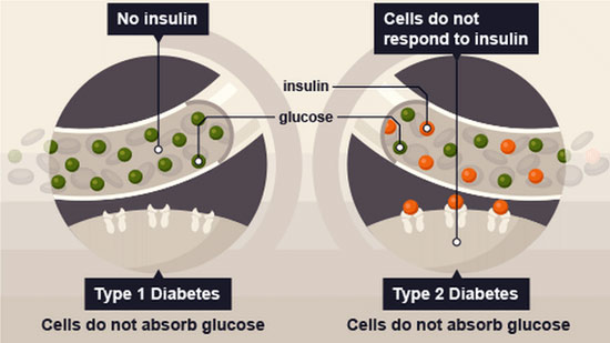 2 Pantangan Tipe Makanan Diabetes