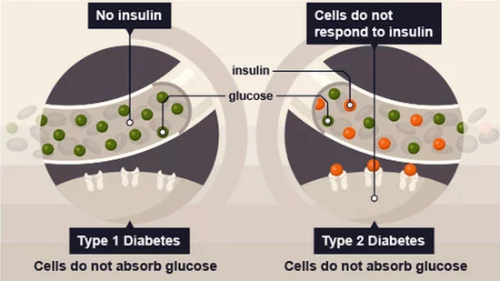 types-of-diabetes-type1-vs-type2