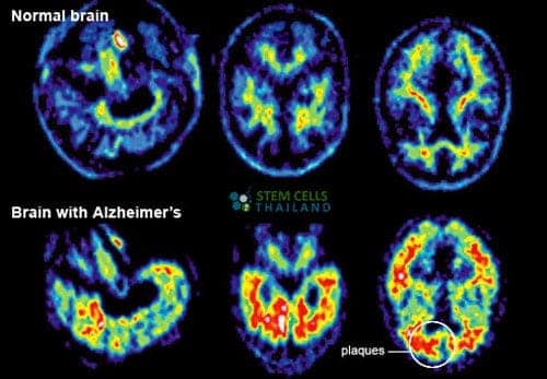 Brain Stem Cells Help Bring back feelings for Paralyzed