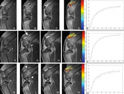 stem-cell-arthritis-treatments-bangkok