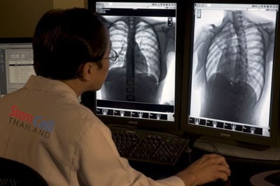 cystic fibrosis lungs vs healthy lungs