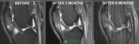 before-after-PRP-platelet-rich-plasma-stemc-cell-therapy-thailand-MRI