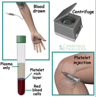 PRP Enriched Plasma Rich Injection Therapy