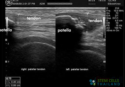 prp-therapy-before-after-scan-thailand-plasma-platelet-rich