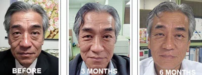 prp-treatment-before-after-man-cosmetic-prp-plasma-platelet-rich
