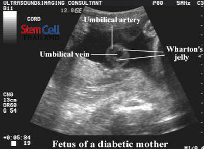 whartons-jelly-ultrasound-pregnant