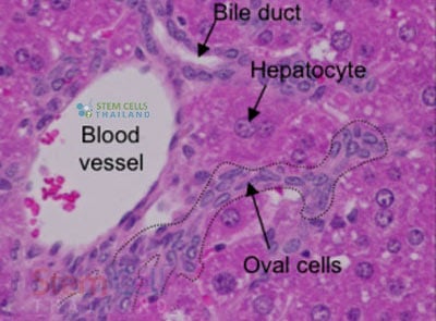 bangkok-cell-therapy-kidney-hepatocytes-cirrhosis-treatment-prices