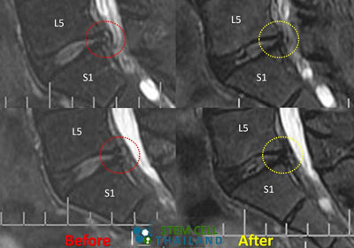 before-after-mri-stem-cells-sports-injuries-prp-Orthokine-regenokine