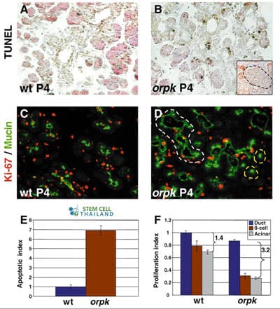 Polycystic-kidney-disease-stem-cell-therapy-before-after-test