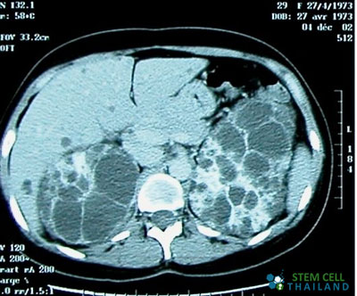 Polycystic-kidney-disease-stem-cell-treatment-mri