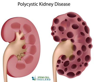 Polycystic-kidney-disease-therapy-before-after-stem-cells