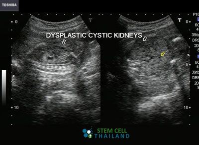 aplastic-Polycystic-kidney-disease-treatment-stem-cell-treatment-CTscan