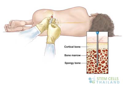 Bone Marrow Function Aspiration Cell Transplants