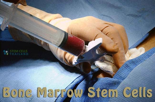 Bone marrow stem cell extraction