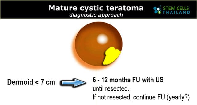 teratoma treatment diagnostic stem cell