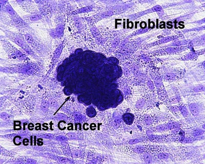 fibroblasts-breast-cancer-cells