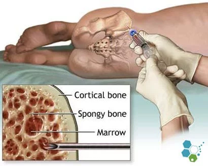 iliac-crest-bone-marrow-stem-cells