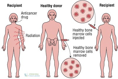 bone marrow hematopoietic stem cells