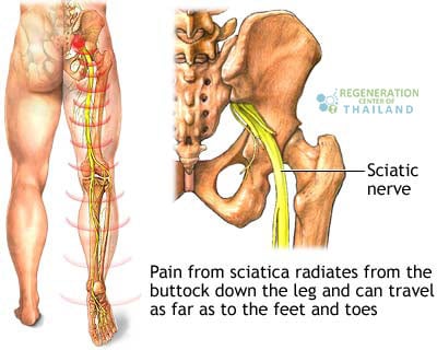 treat-sciatic-nerves-Sciatica