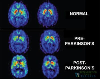 stages-of-parkinsons