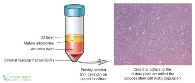 Stromal-Vascular-Fraction-SVF-Cells-therapy