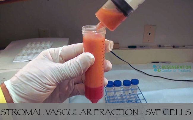 Stromal Vascular Fraction SVF Cells