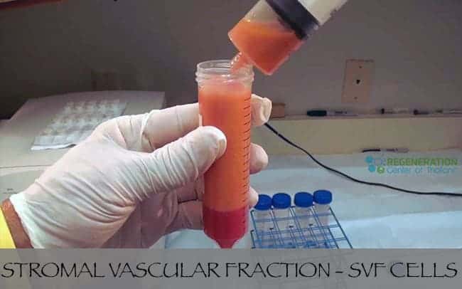 Stromal-Vascular-Fraction-SVF-StemCells