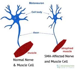 Spinal-muscular-atrophy-treatment-stemcells