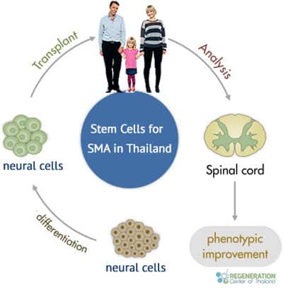 gene-therapy-neural-cells-treatment-sma