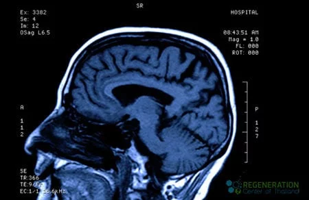 traumatic-brain-injury-treatment-stem-cells-bangkok