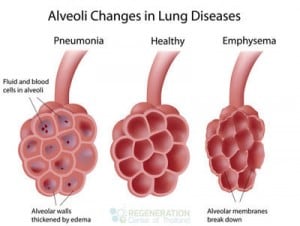 Bronchoalveolar Stem Cells for Treatment of IPF & Lung Fibrosis