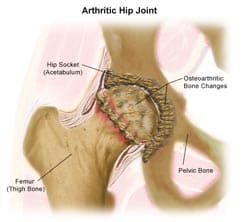 arthritic-hip-joint