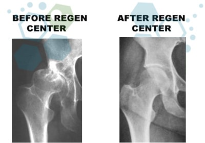 before-after-hip-arthritis-stem-cell-therapy