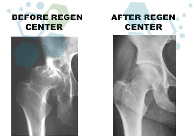 You Can Get Relief for These 5 Painful Hip Conditions: Dr. Stem Cell:  Regenerative Orthopedics