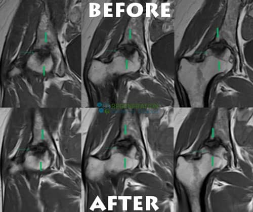 before-after-stemcell-hip