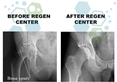 before-hip-stem-cell-therapy avoid hip replacement surgeries