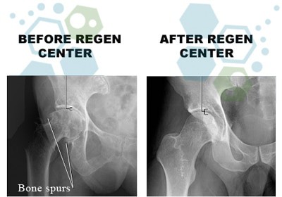 You Can Get Relief for These 5 Painful Hip Conditions: Dr. Stem Cell:  Regenerative Orthopedics