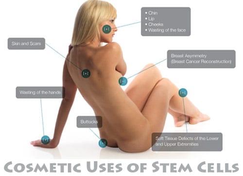 Stem Cell-Enriched Fat Injection in Aesthetic, Reconstructive Breast  Surgery