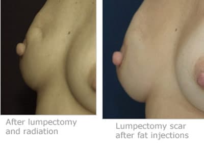 fat-grafting-post-mastectomy-lumpectomy