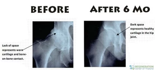 hip-regeneration-stem-cells-before-after