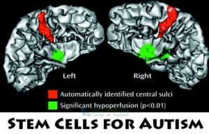 stem-cell-autism-treatments-thailand